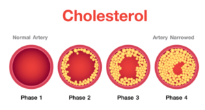 Diagram of cholesterol in artery